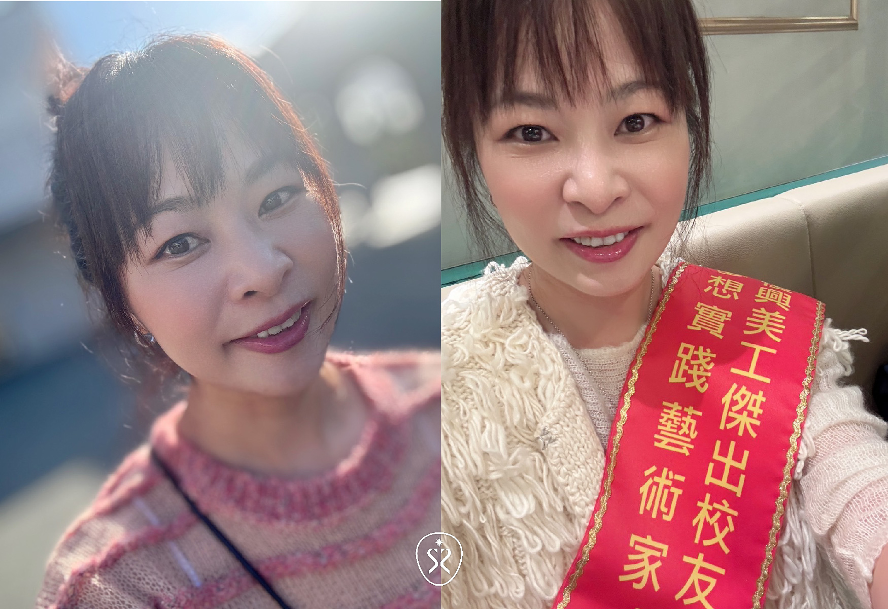 【玻尿酸淚溝及法令紋】星采皮膚專科診所(古亭)-好好保養，好好愛自己-Bella莊蕙如